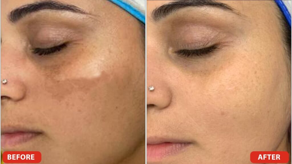 Pigmentation