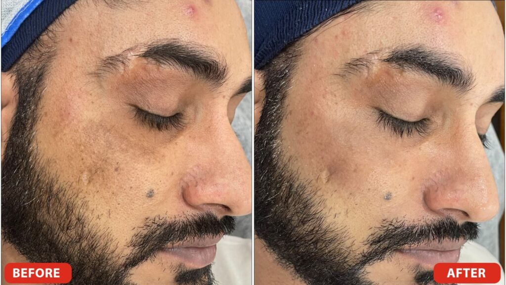 Pigmentation